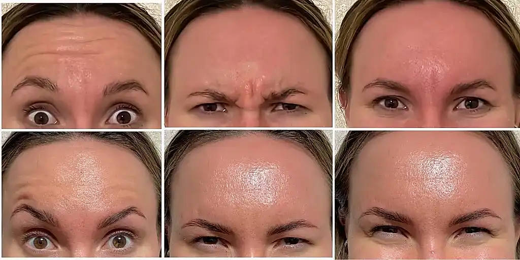 ботокс коллаж.jpg ботокс коллаж.jpg