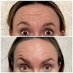 Ботулотоксин 3