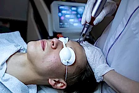 Лазерное лечение акне