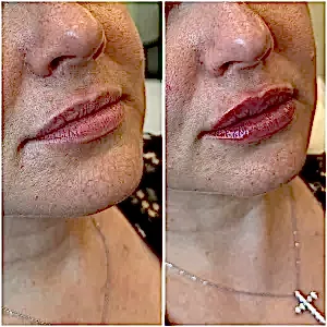 Контурная пластика губ 