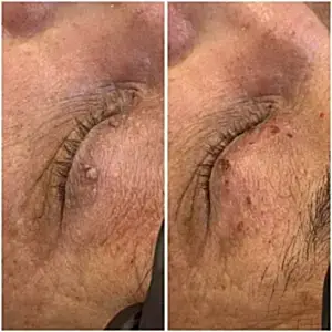 Удаление папиллом на веке