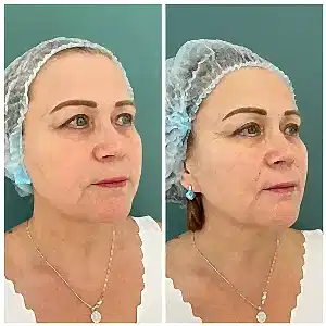 Контурная пластика 4