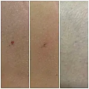 Лечение гемангиомы