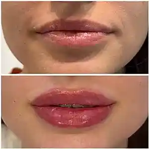 Увеличение губ 23