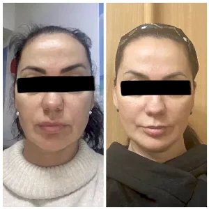 Смас лифтинг UCOS HIFU