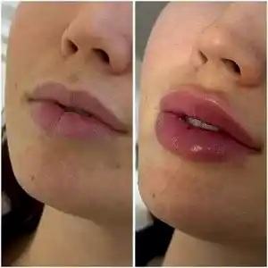 Контурная пластика губ 