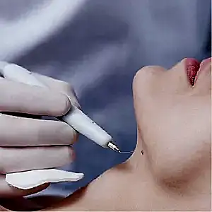 Удаление новообразований электрокоагулятором