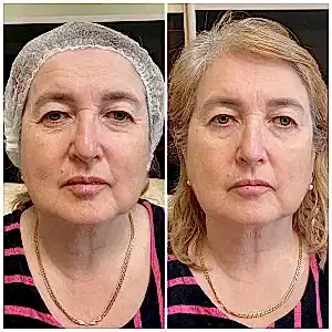 Биоревитализация