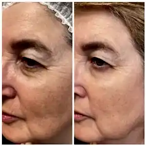 Биоревитализация 2