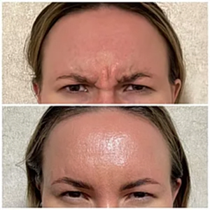 Ботулотоксин