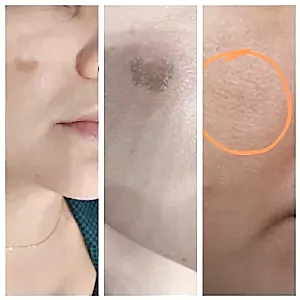 Удаление пигментного пятна