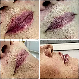 Контурная пластика губ