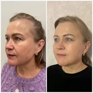 Смас лифтинг UCOS HIFU