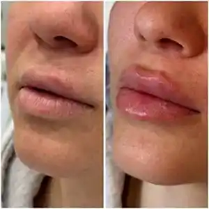 Контурная пластика губ 26