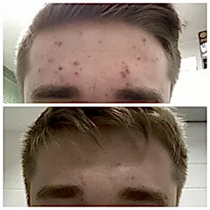 Лечение акне средней степени тяжести