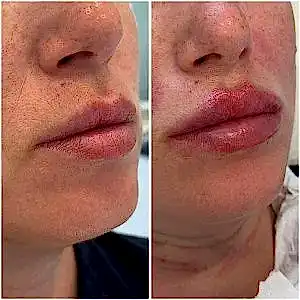 Увеличение губ 22