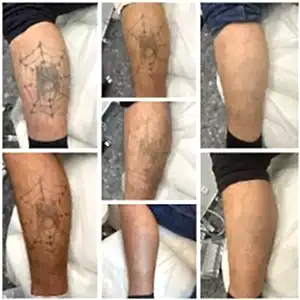 Удаление татуировки, 7 процедур.