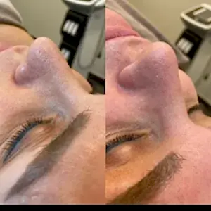 Комбинированная чистка 