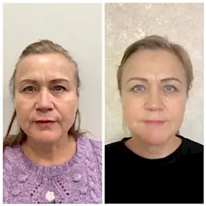 Смас лифтинг UCOS HIFU