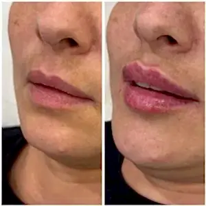 Увеличение губ 24