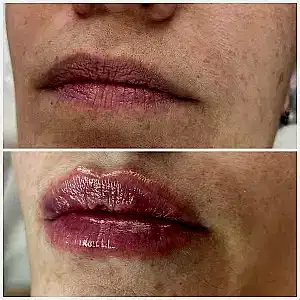 Контурная пластика губ