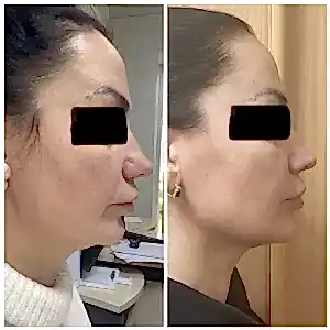 Смас лифтинг UCOS HIFU