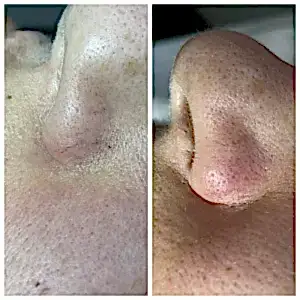 Лазерное удаление купероза на крыльях носа