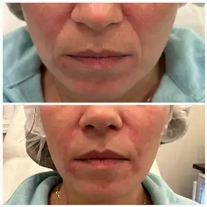 Коррекция носогубных морщин