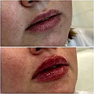 Контурная пластика губ