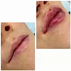 Контурная пластика губ 