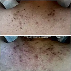 Чистка спины