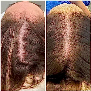 PRP терапия кожи головы