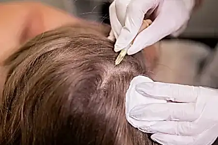 Мезотерапия для волос