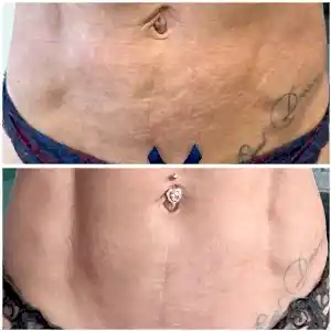 Микроиглы живот 