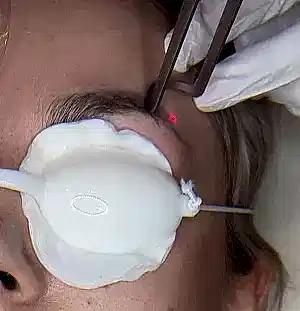 Лазерное удаление татуажа