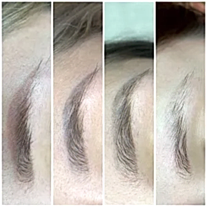 Удаление татуажа бровей