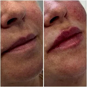 Деликатное увеличение губ.