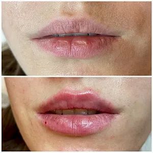 Контурная пластика губ