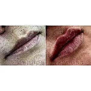 Контурная пластика губ