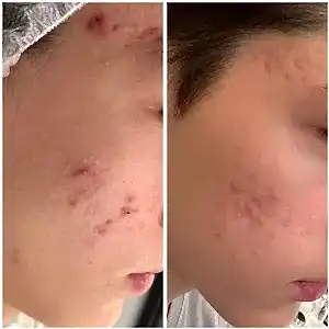 Лечение акне 2