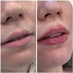 Увеличение губ 21