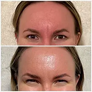 Ботулотоксин 2