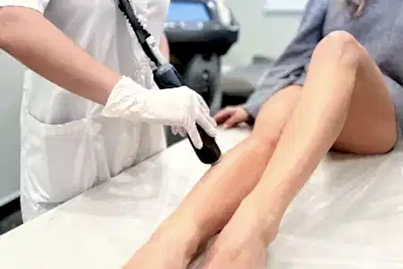 Лазерная эпиляция