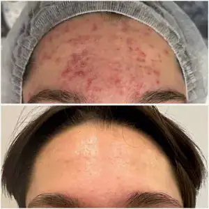 Лечение акне