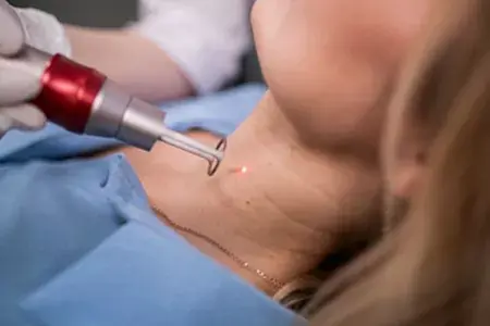 Лазерное удаление новообразований