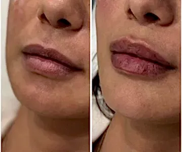 Контурная пластика губ 27