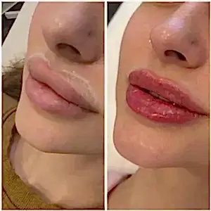 Удаление филера лонгидазой