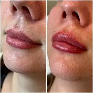 Контурная пластика губ 