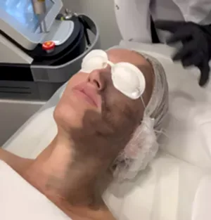 Карбоновый пилинг