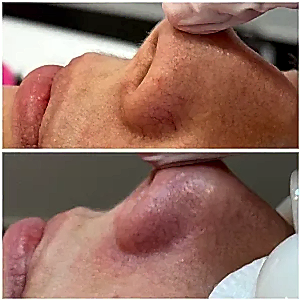 Устранение купероза на крыльях носа